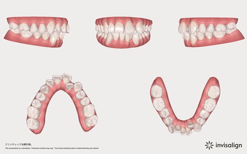 部分的な矯正もインビザラインドクターにお任せ