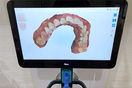 iTero(アイテロ)